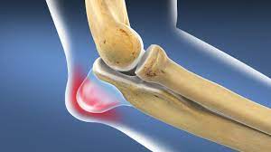 Excizia bursita - Arth-Orthopedics - Dr. Pop Daniel Laurentiu